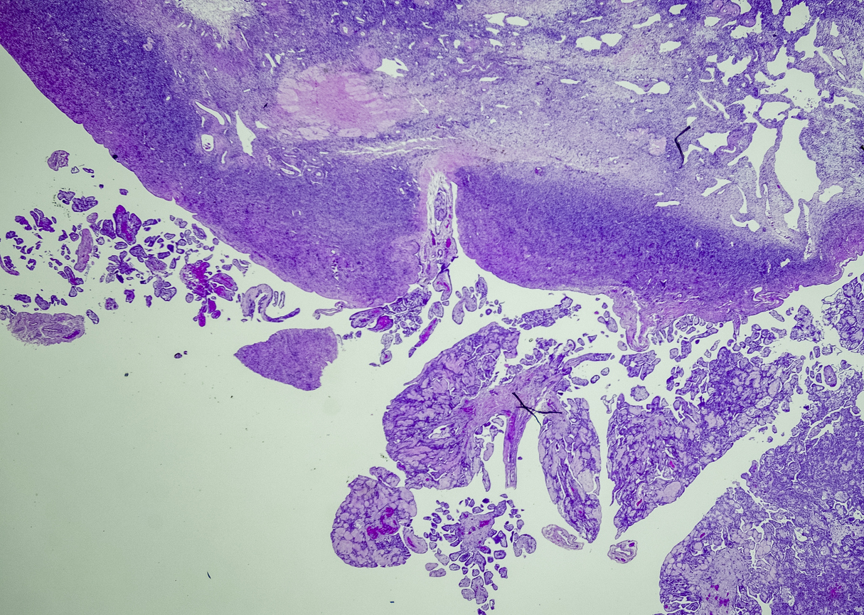 Well-differentiated papillary mesothelioma