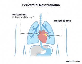 Diagram shows pericardial mesothelioma tumors forming on the smooth lining around the heart.