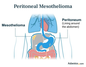 Peritoneal Mesothelioma