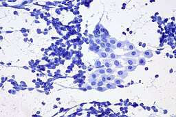 Microscope view of benign mesothelial cells.