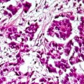 Lymphohistiocytoid mesothelioma