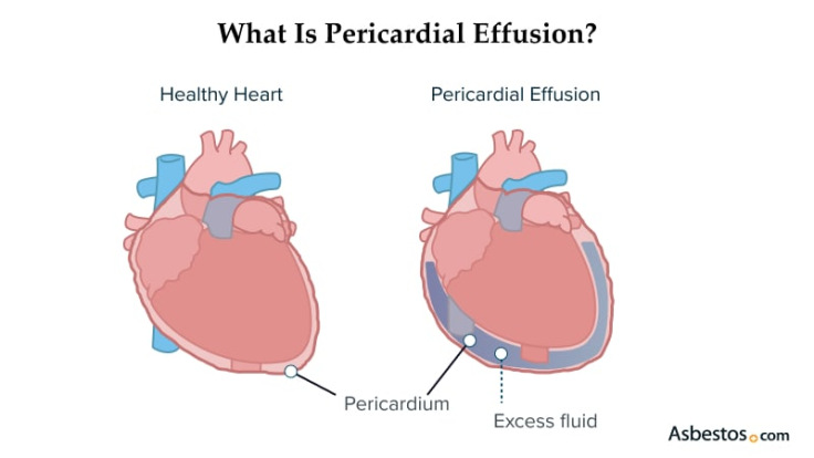 What is Pericardial Effusion?
