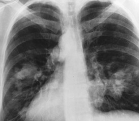 X-ray of lungs