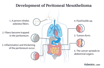 How peritoneal mesothelioma develops from asbestos fibers.