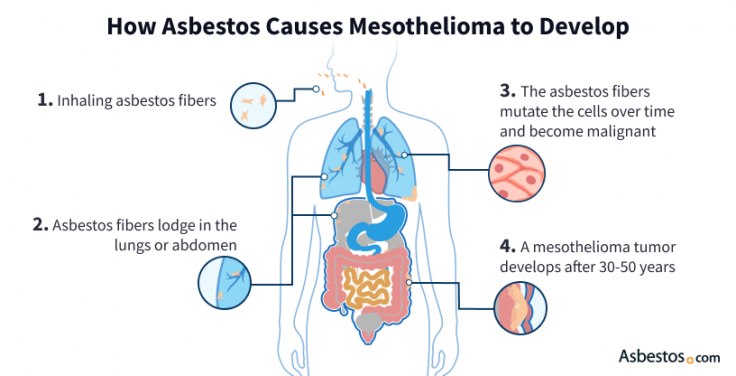 Diagram showing how asbestos fibers are inhaled, lodge in the lung or abdominal lining, slowly mutate surrounding cells over decades, and lead to a mesothelioma tumor after 30-50 years later.