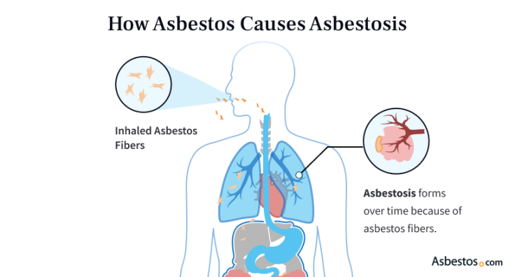 How asbestos causes asbestosis