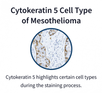 Cytokeratin 5 mesothelioma cells under microscope