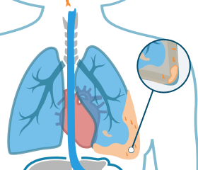 Where Mesothelioma Cancer Develops in the Lungs