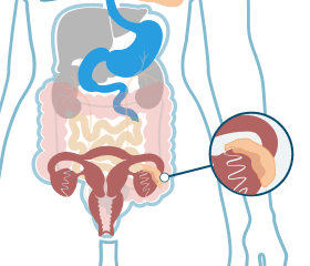 Where ovarian cancer develops