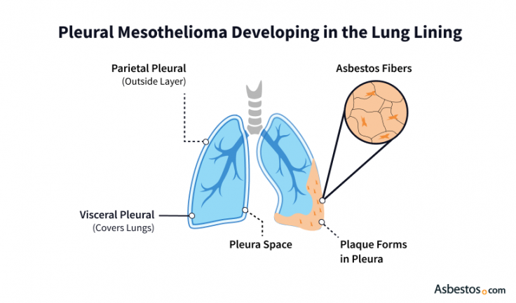 How pleural mesothelioma develops in the lung linings.