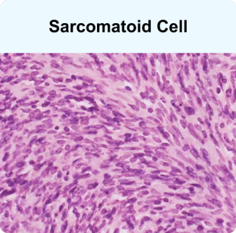 Sarcomatoid cell, a mesothelioma cell type