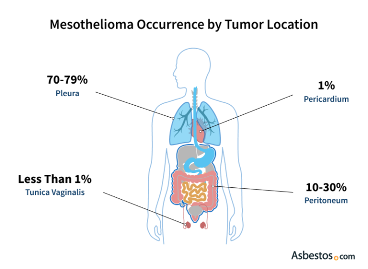 Diagram showing a percentage breakdown of each mesothelioma type
